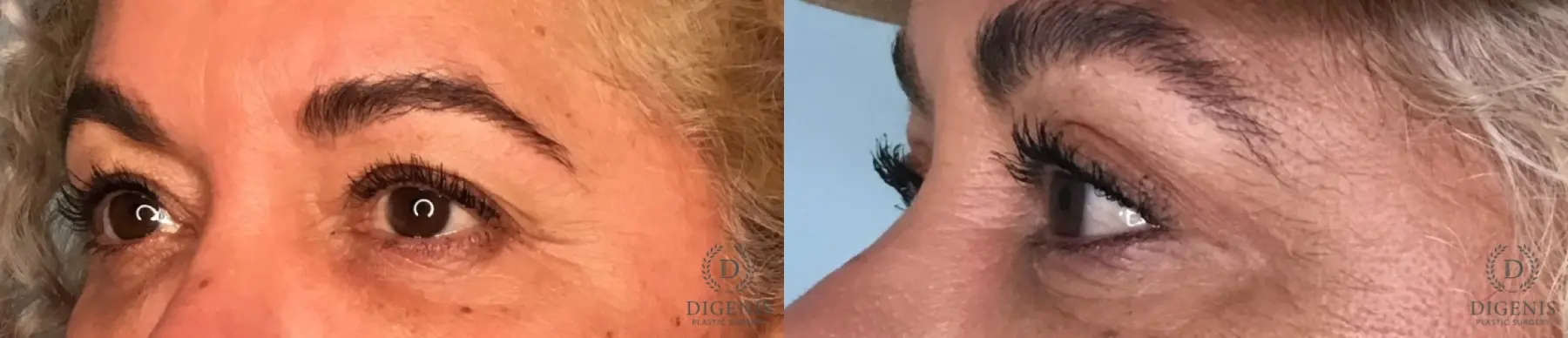 Eyelid Surgery: Patient 13 - Before and After 2
