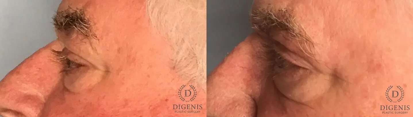 Eyelid Surgery: Patient 8 - Before and After 3