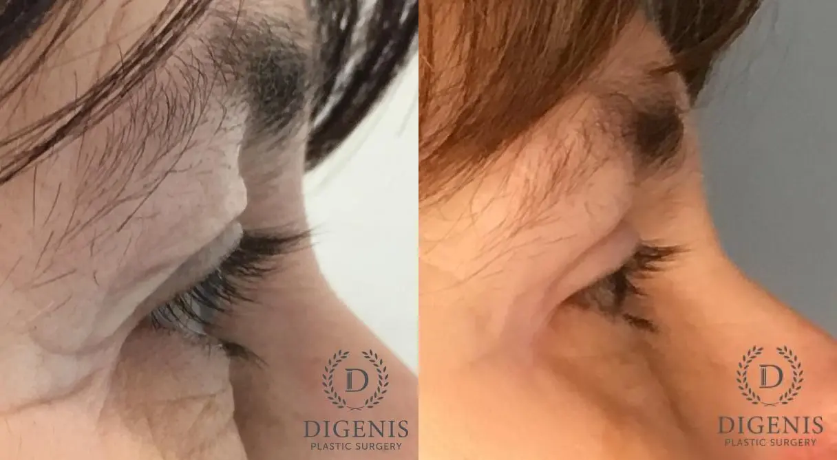 Eyelid Surgery: Patient 64 - Before and After 2
