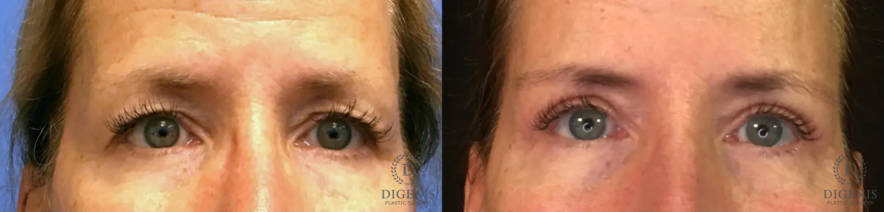 Eyelid Surgery: Patient 2 - Before and After  