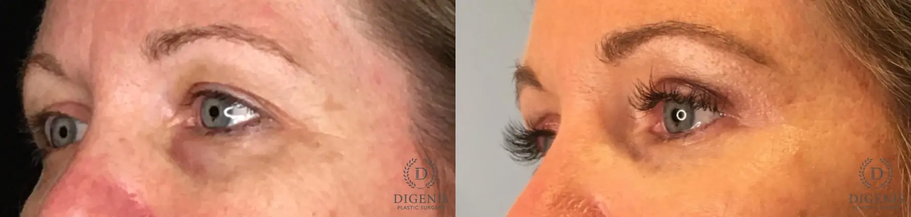 Eyelid Surgery: Patient 52 - Before and After 3
