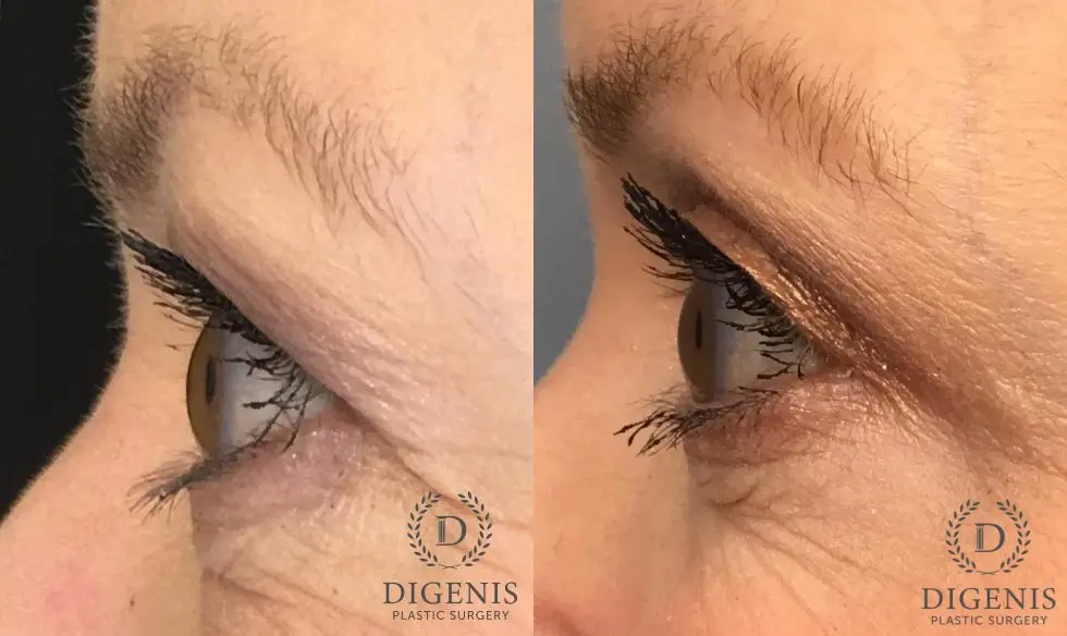 Eyelid Surgery: Patient 14 - Before and After 5