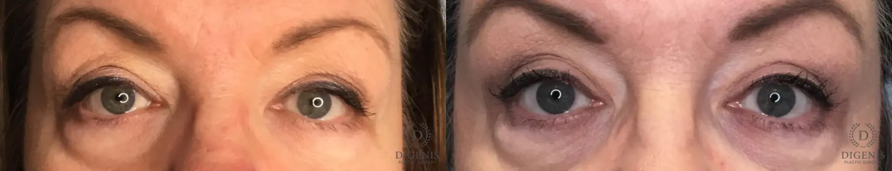 Eyelid Surgery: Patient 9 - Before and After  