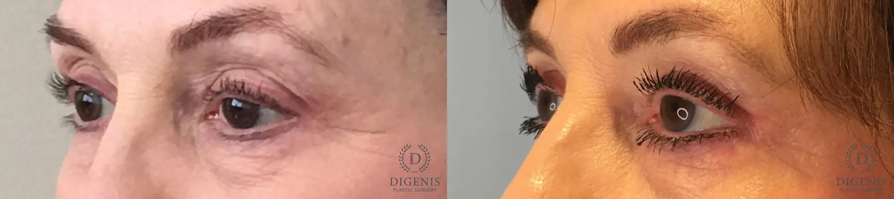 Eyelid Surgery: Patient 57 - Before and After 4