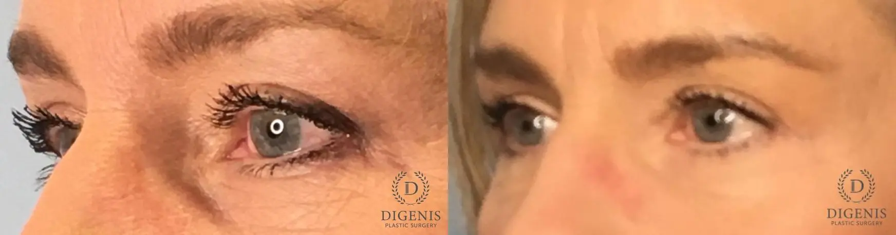 Eyelid Surgery: Patient 65 - Before and After 4