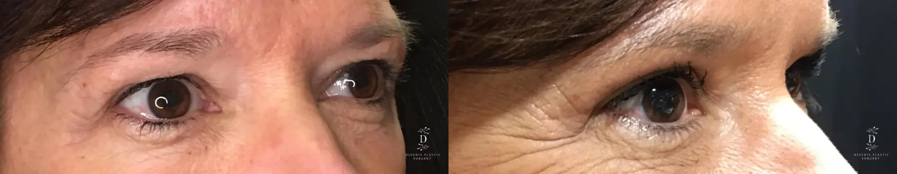 Eyelid Surgery: Patient 27 - Before and After 2