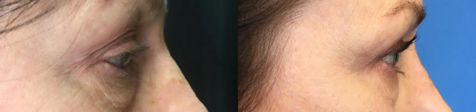 Eyelid Surgery: Patient 24 - Before and After 3