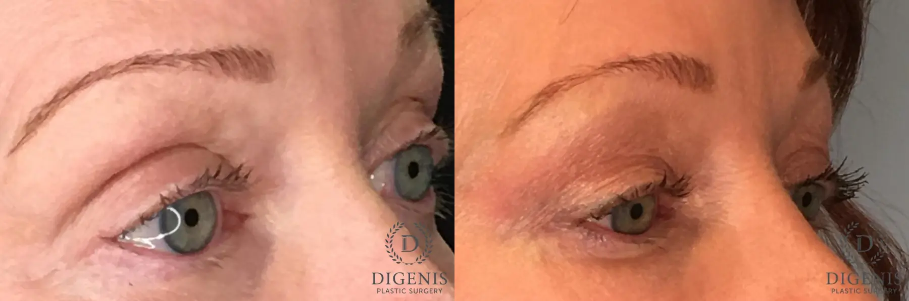 Eyelid Surgery: Patient 53 - Before and After 4