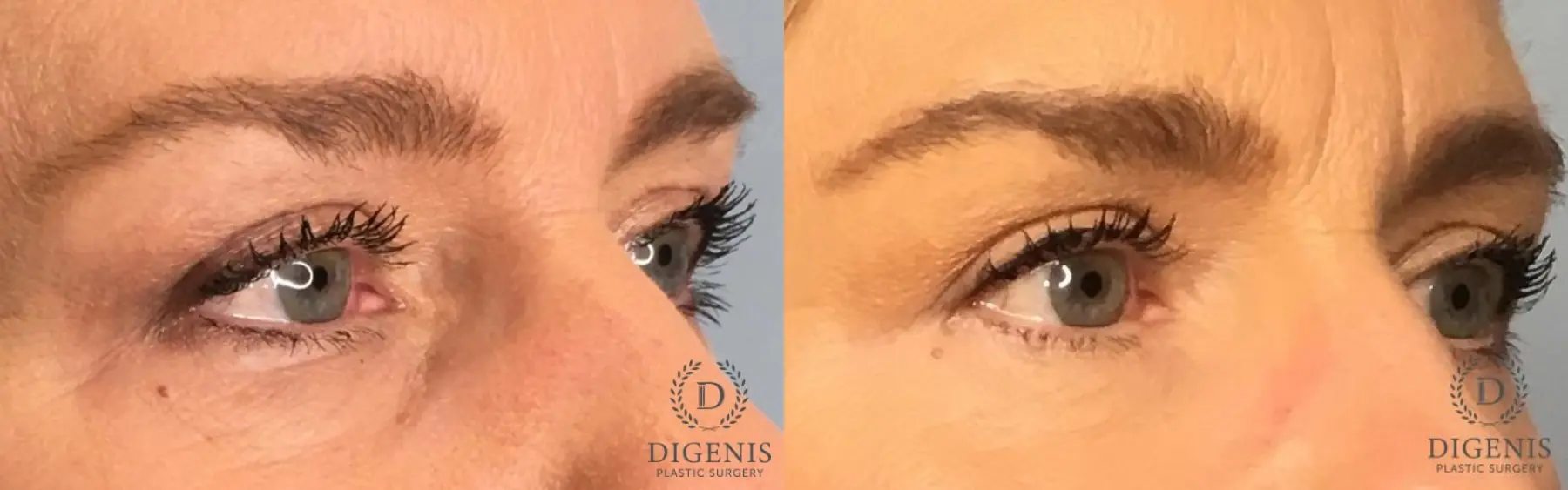 Eyelid Surgery: Patient 65 - Before and After 2