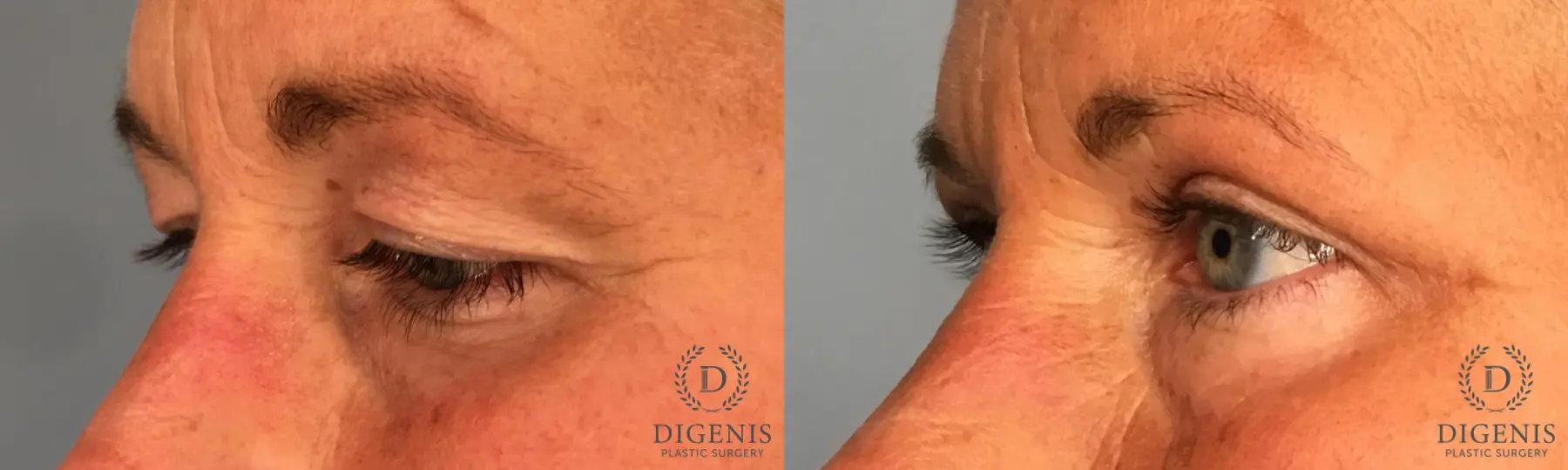 Eyelid Surgery: Patient 69 - Before and After 2