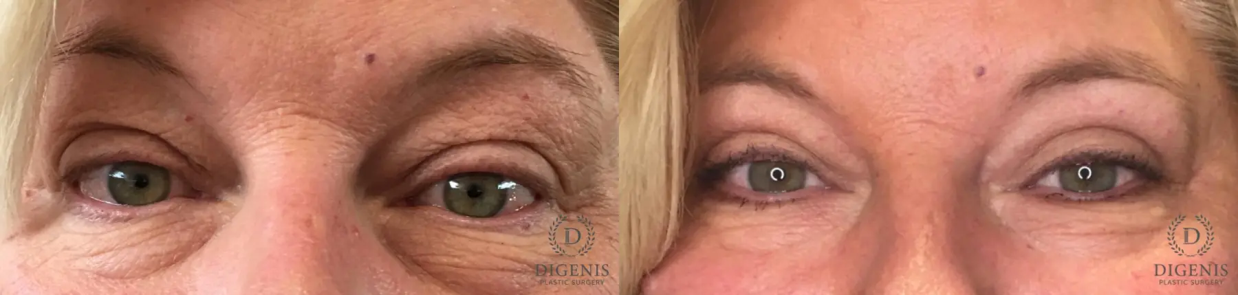 Eyelid Surgery: Patient 62 - Before and After 1