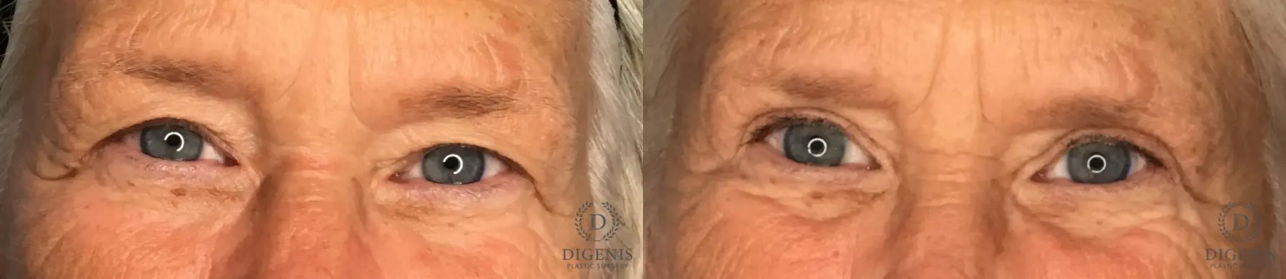 Eyelid Surgery: Patient 4 - Before and After  