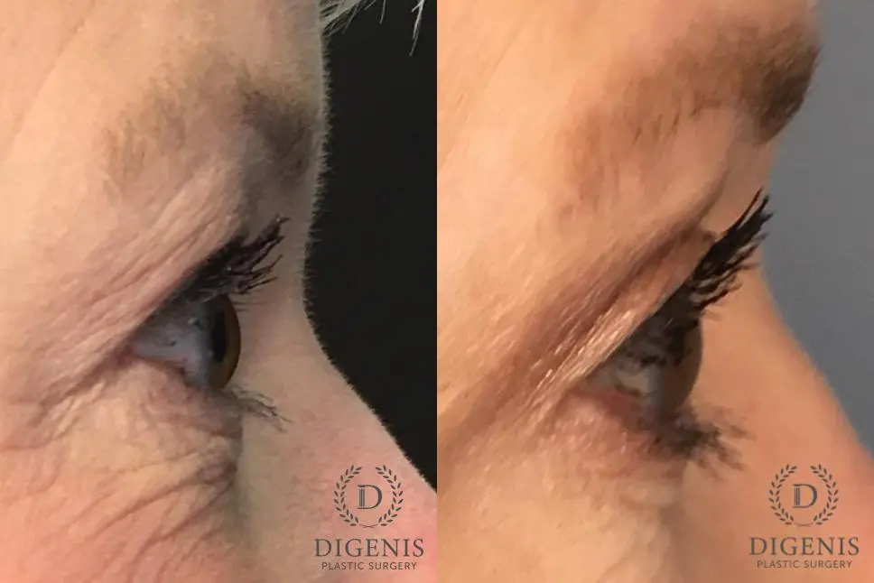 Eyelid Surgery: Patient 14 - Before and After 3