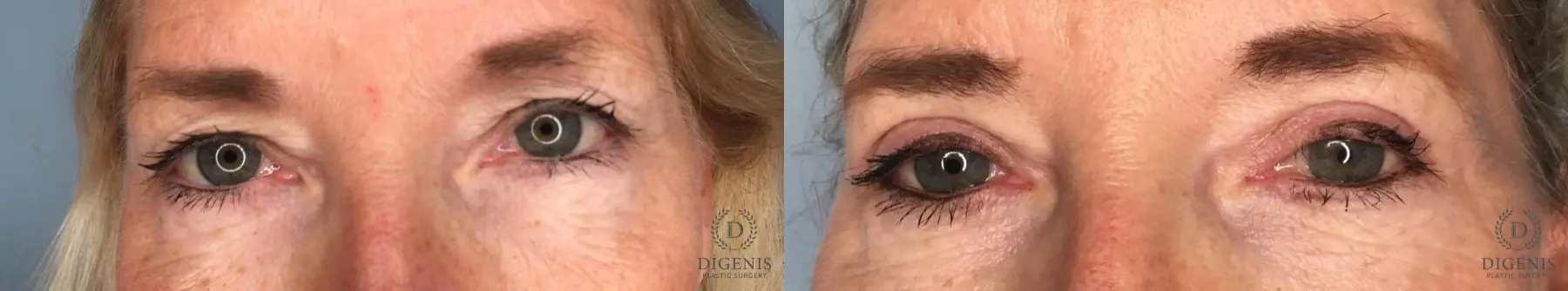 Eyelid Surgery: Patient 6 - Before and After  