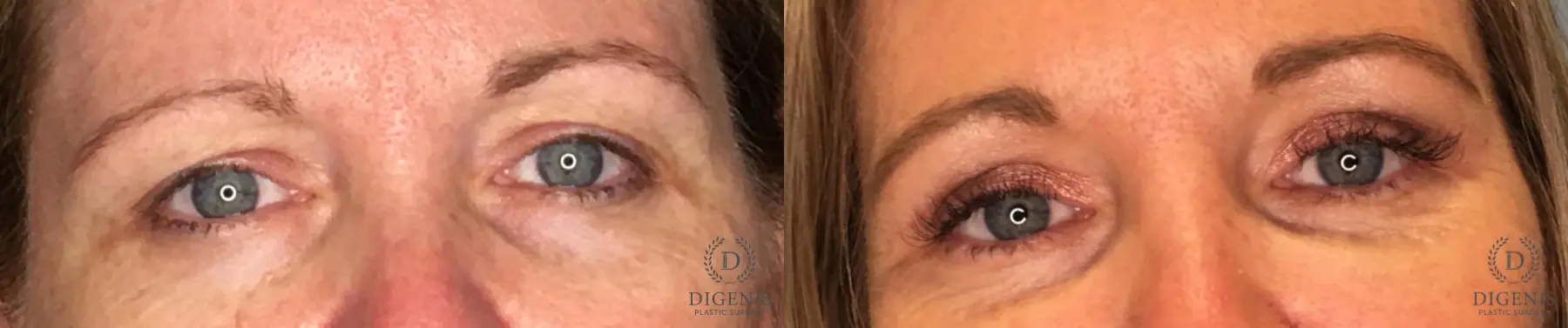 Eyelid Surgery: Patient 52 - Before and After 1