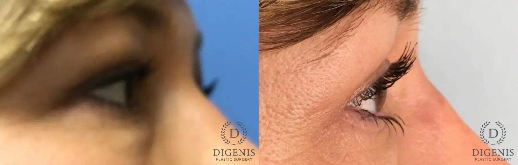 Eyelid Surgery: Patient 63 - Before and After 5