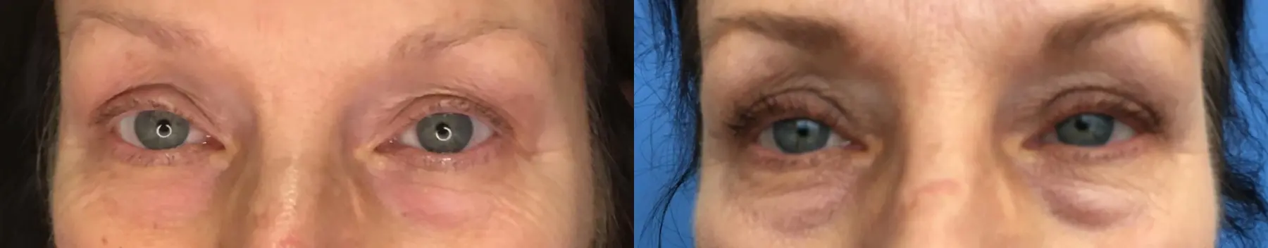 Eyelid Surgery: Patient 24 - Before and After  