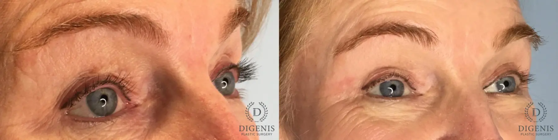Eyelid Surgery: Patient 71 - Before and After 4