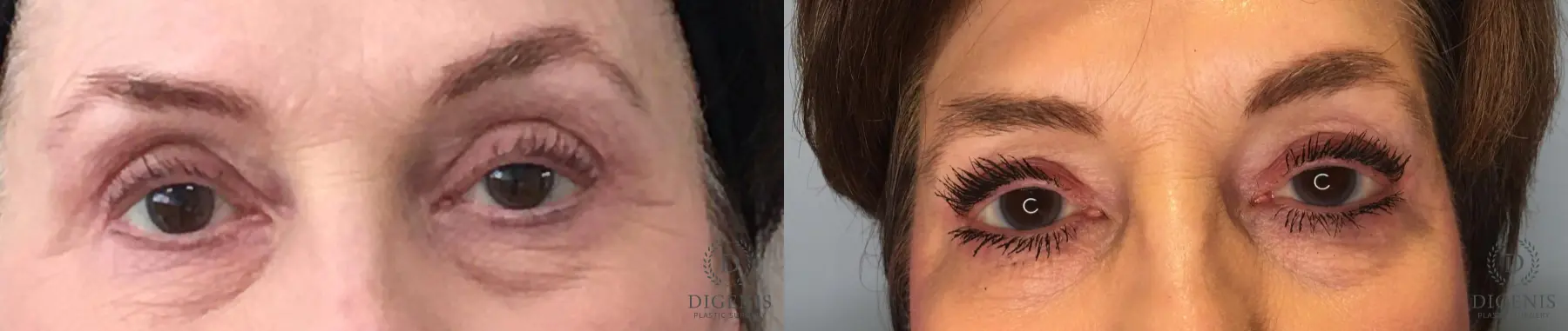 Eyelid Surgery: Patient 57 - Before and After  