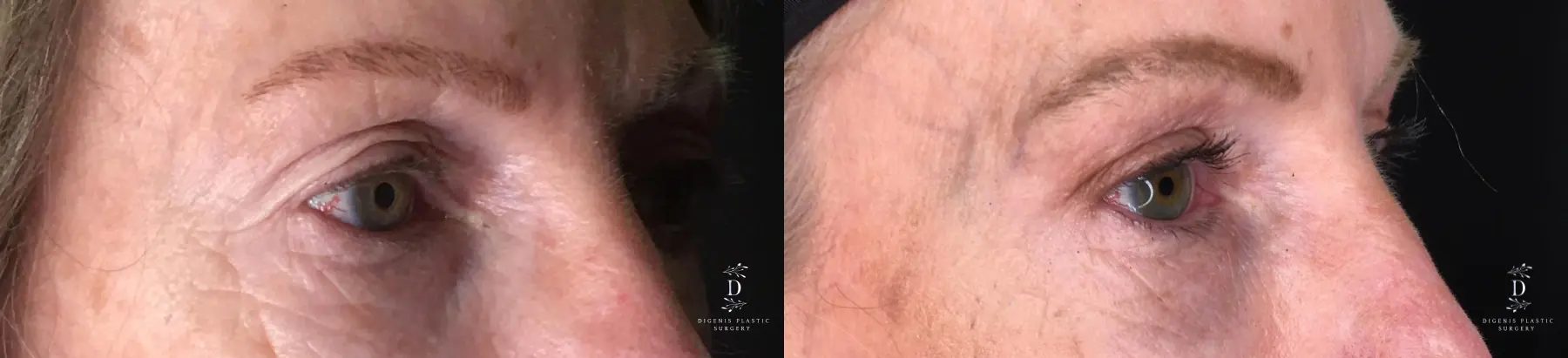Eyelid Surgery: Patient 23 - Before and After 2