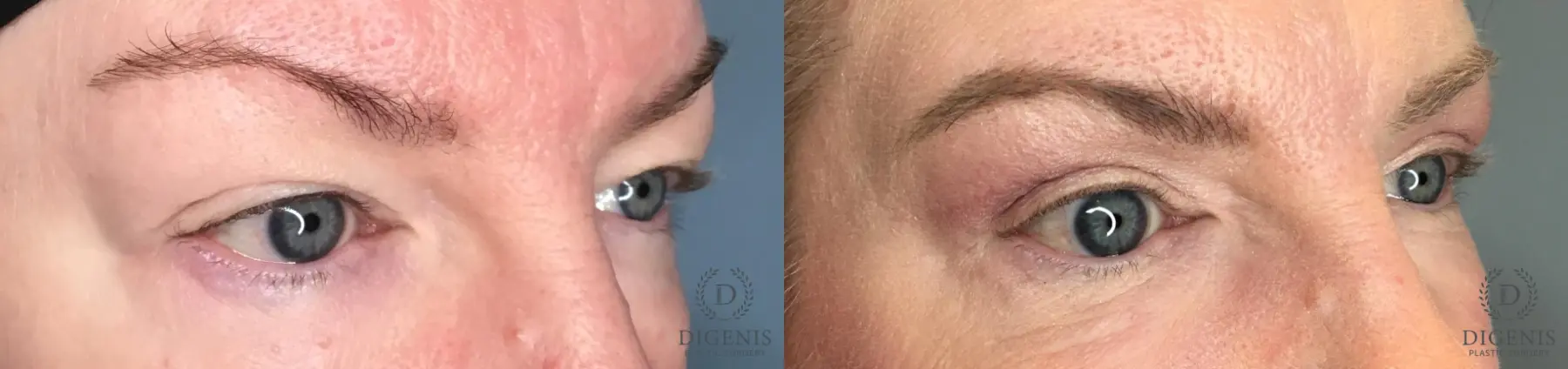 Eyelid Surgery: Patient 47 - Before and After 4