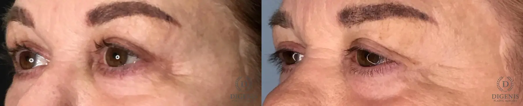 Eyelid Surgery: Patient 11 - Before and After 3