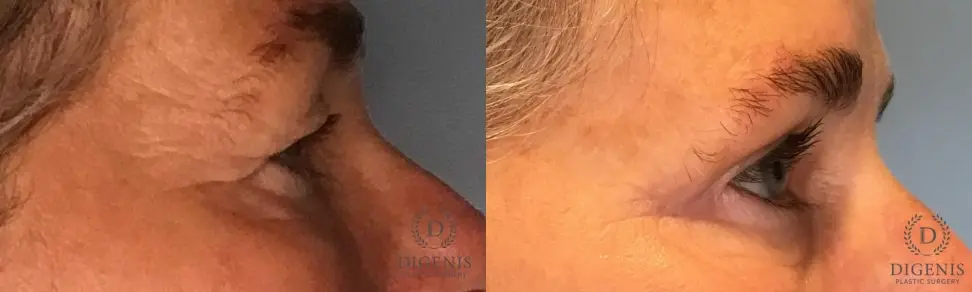 Eyelid Surgery: Patient 76 - Before and After 3