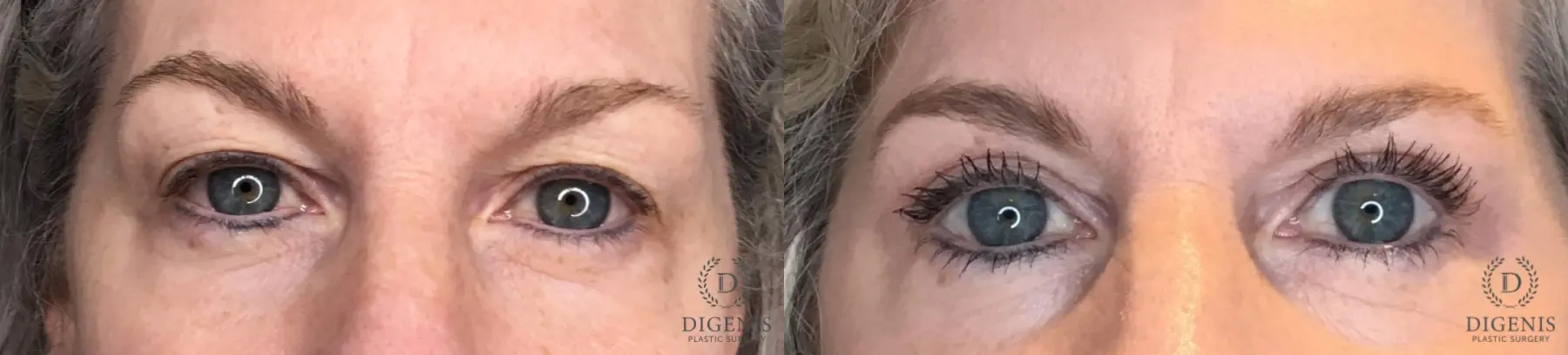 Eyelid Surgery: Patient 81 - Before and After  