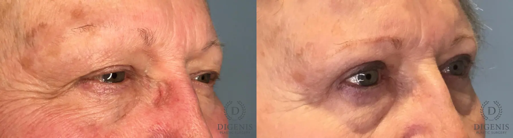 Eyelid Surgery: Patient 75 - Before and After 3