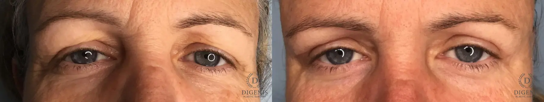 Eyelid Surgery: Patient 5 - Before and After  