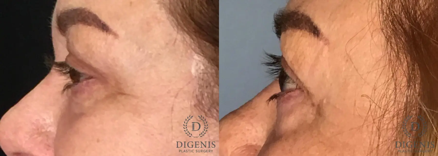 Eyelid Surgery: Patient 11 - Before and After 4