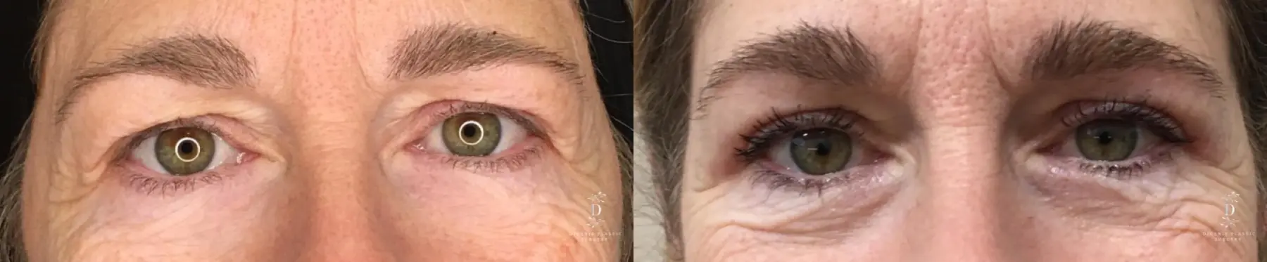 Eyelid Surgery: Patient 32 - Before and After 1