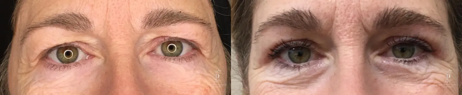 Eyelid Surgery: Patient 32 - Before and After  