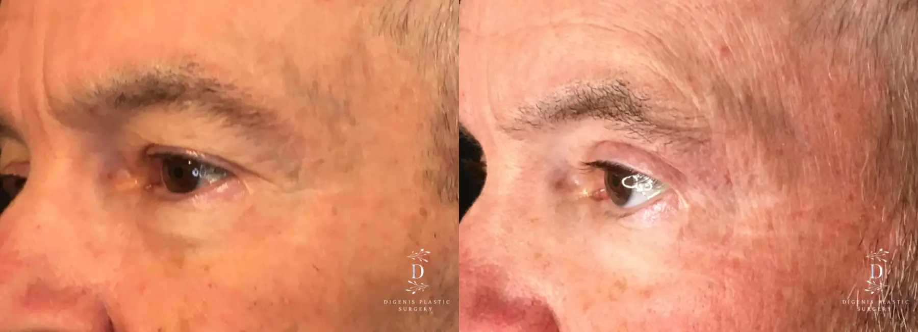 Eyelid Surgery: Patient 19 - Before and After 4