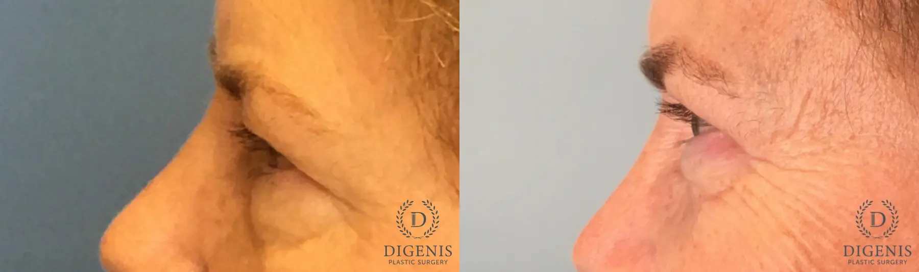 Eyelid Surgery: Patient 58 - Before and After 5