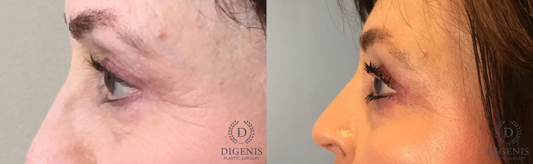 Eyelid Surgery: Patient 57 - Before and After 5