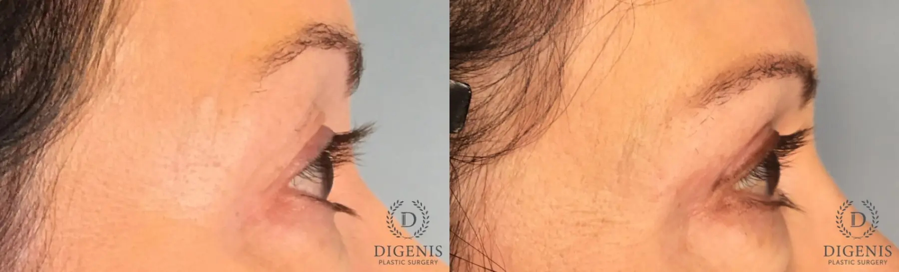 Eyelid Surgery: Patient 72 - Before and After 4
