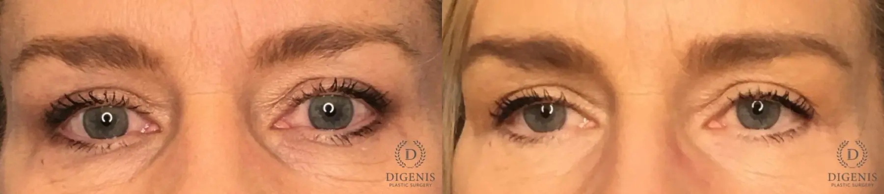 Eyelid Surgery: Patient 65 - Before and After 1
