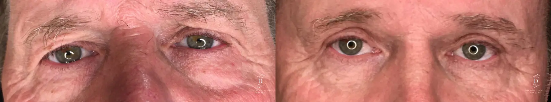 Eyelid Surgery: Patient 31 - Before and After 1