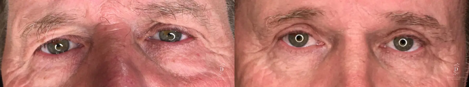 Eyelid Surgery: Patient 31 - Before and After  