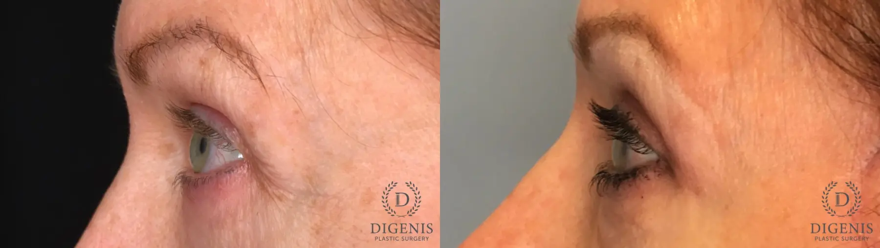 Eyelid Surgery: Patient 56 - Before and After 5