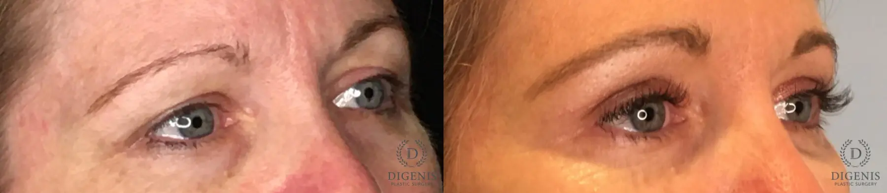 Eyelid Surgery: Patient 52 - Before and After 2