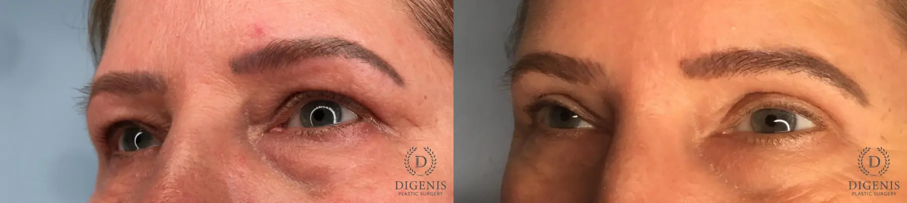 Eyelid Surgery: Patient 74 - Before and After 2