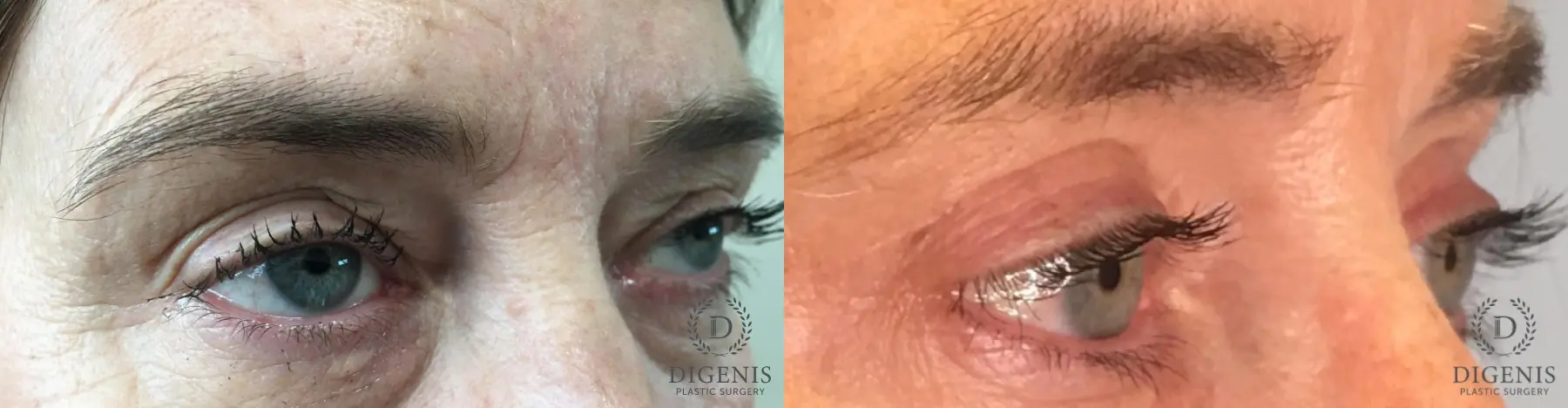 Eyelid Surgery: Patient 60 - Before and After 3