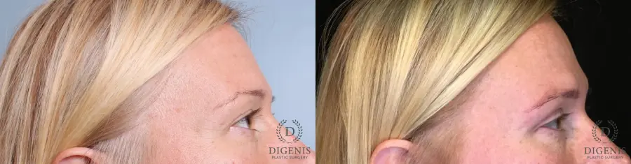 Eyelid Surgery: Patient 10 - Before and After 2