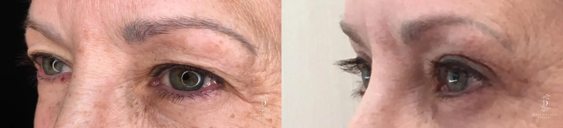 Eyelid Surgery: Patient 29 - Before and After 4