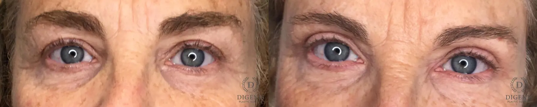 Eyelid Surgery: Patient 10 - Before and After 2
