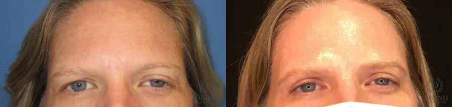 Eyelid Surgery: Patient 7 - Before and After 1
