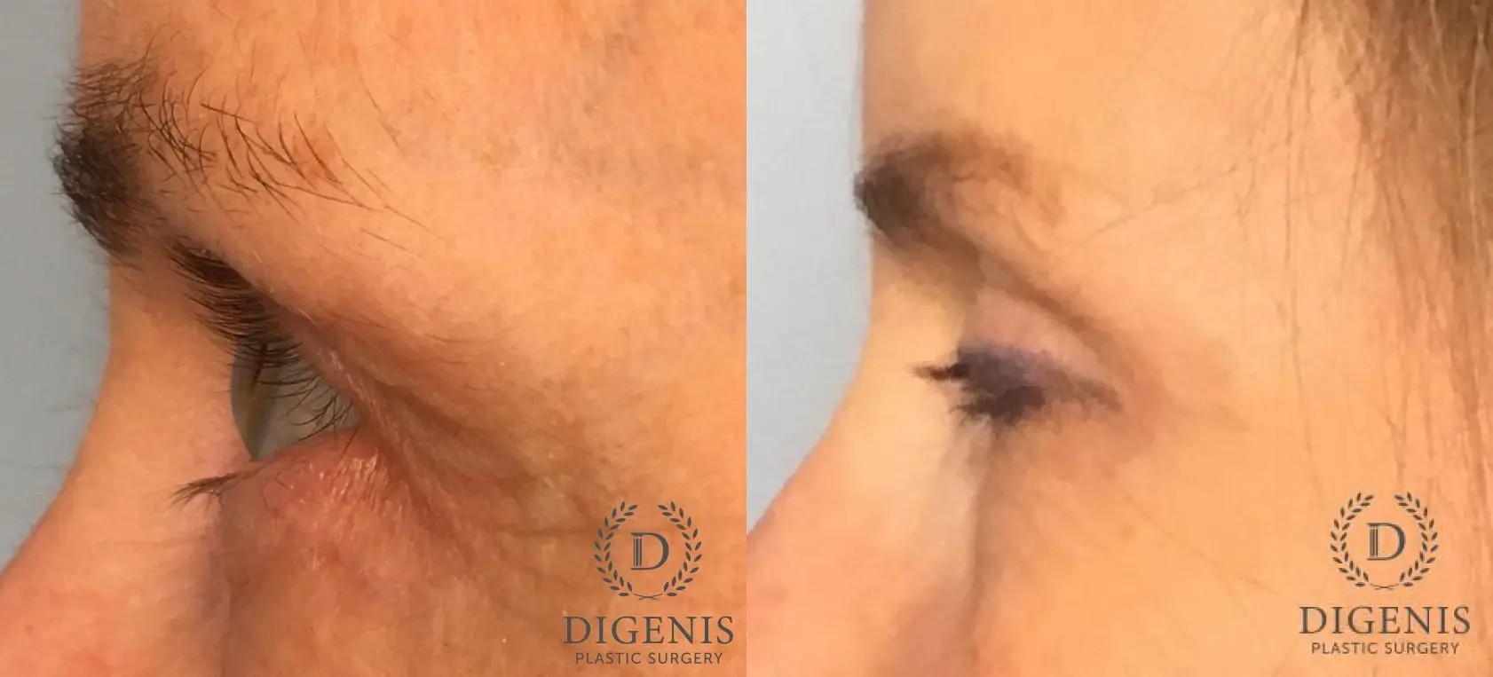 Eyelid Surgery: Patient 66 - Before and After 3