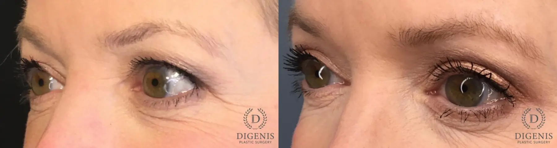 Eyelid Surgery: Patient 14 - Before and After 4